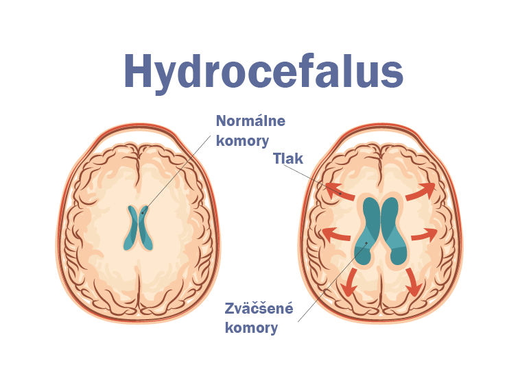 Hydrocefalus 2